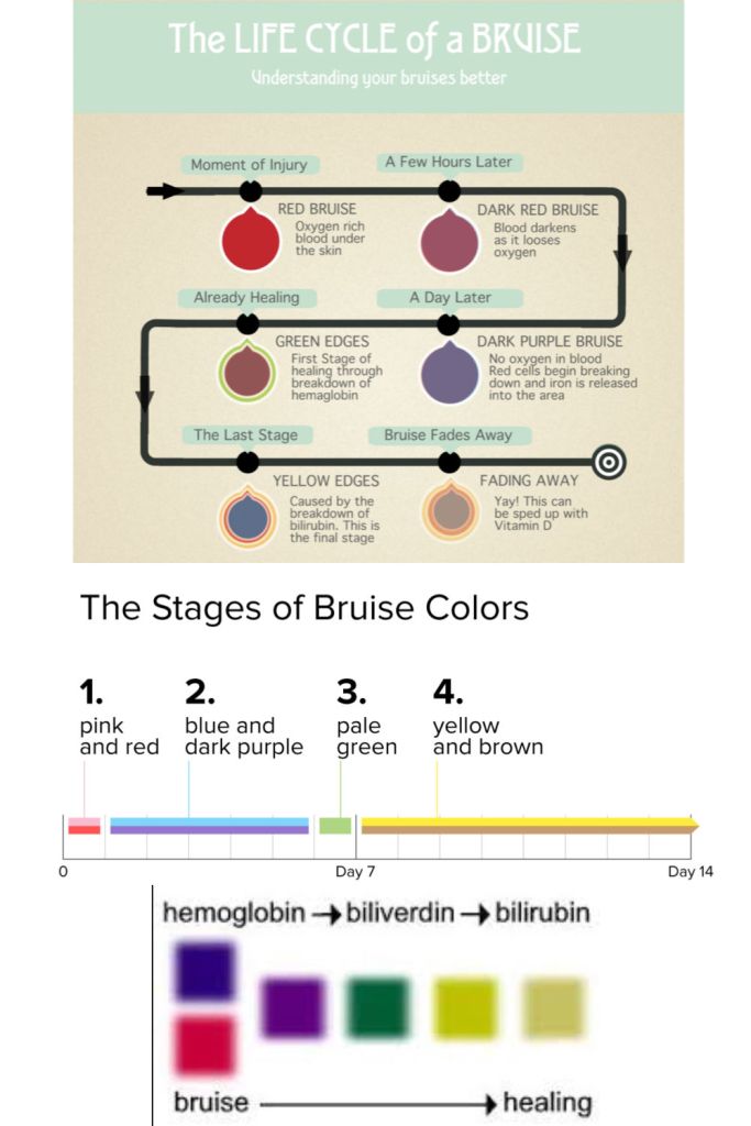Stages Of Bruising Colors Pictures Chart And Differen - vrogue.co